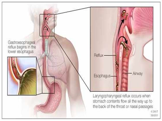 Trào ngược họng thanh quản